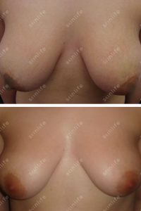 smagliature_066-tonificazione-NEW