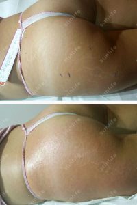 smagliature_083 GLUTEI