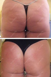 tonificazione GLUTEI-026